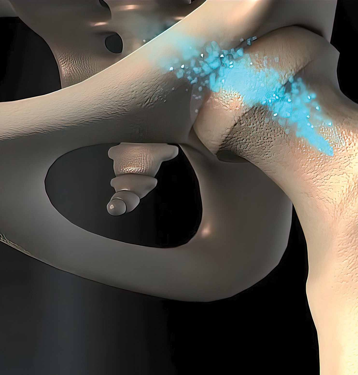 osteoporosi